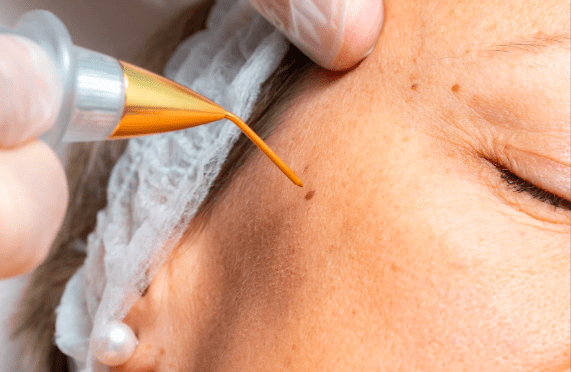 Laser Wart Removal Treatment In Dubai - Dr. Faiez Ghanam Dermatologist,  Cosmetic | د. فايزغنام للأمراض الجلدية والتجميل